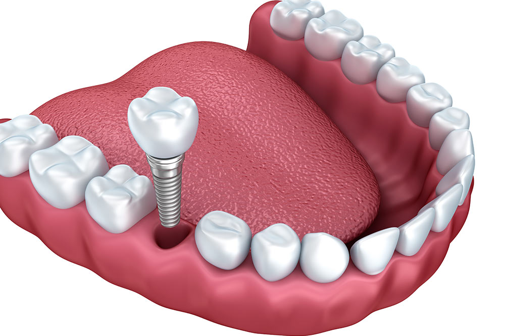Dental Implant treatment 3D image